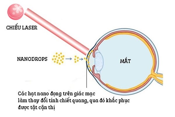 Phương pháp điều trị cận thị với nước nhỏ mắt Nanodrops