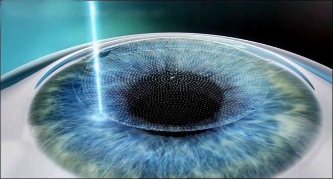 1. Using Laser Femtosecond energy from VISUMAX to create corneal flap.