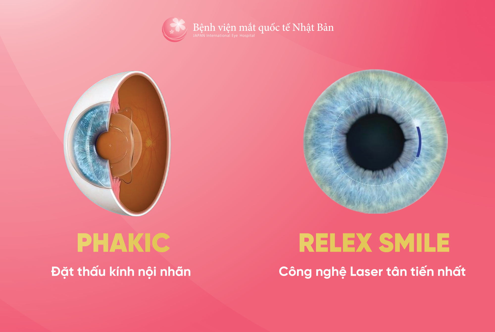 SO SÁNH PHẪU THUẬT RELEX SMILE VÀ PHẪU THUẬT PHAKIC