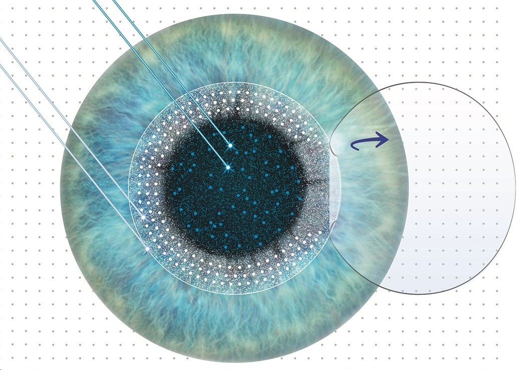 Phẫu thuật Femtosecond Lasik | Bệnh viện mắt quốc tế Nhật Bản