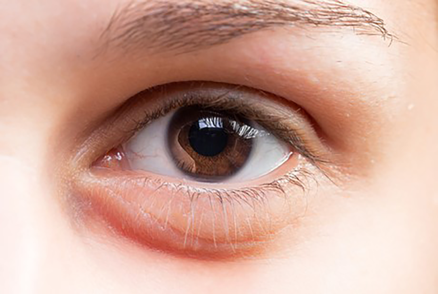 Swollen eyes - Reason and how to prevent them