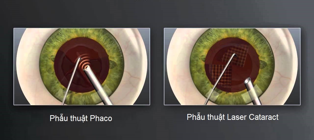 phẫu thuật thay thủy tinh thể