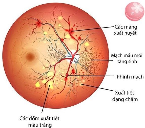 Có những phương pháp điều trị và phòng ngừa nào cho bệnh võng mạc tiểu đường?
