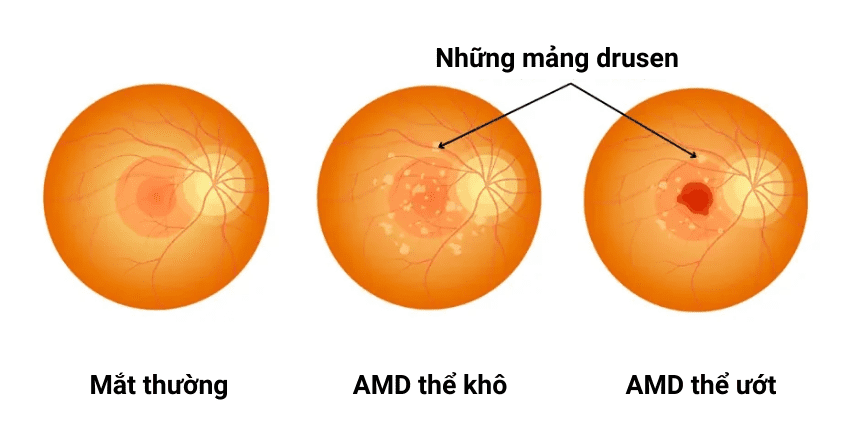 phan-loai-thoai-hoa-diem-vang