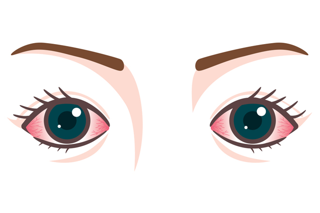 Viêm kết mạc có thể gây tổn thương như thế nào cho mắt?
