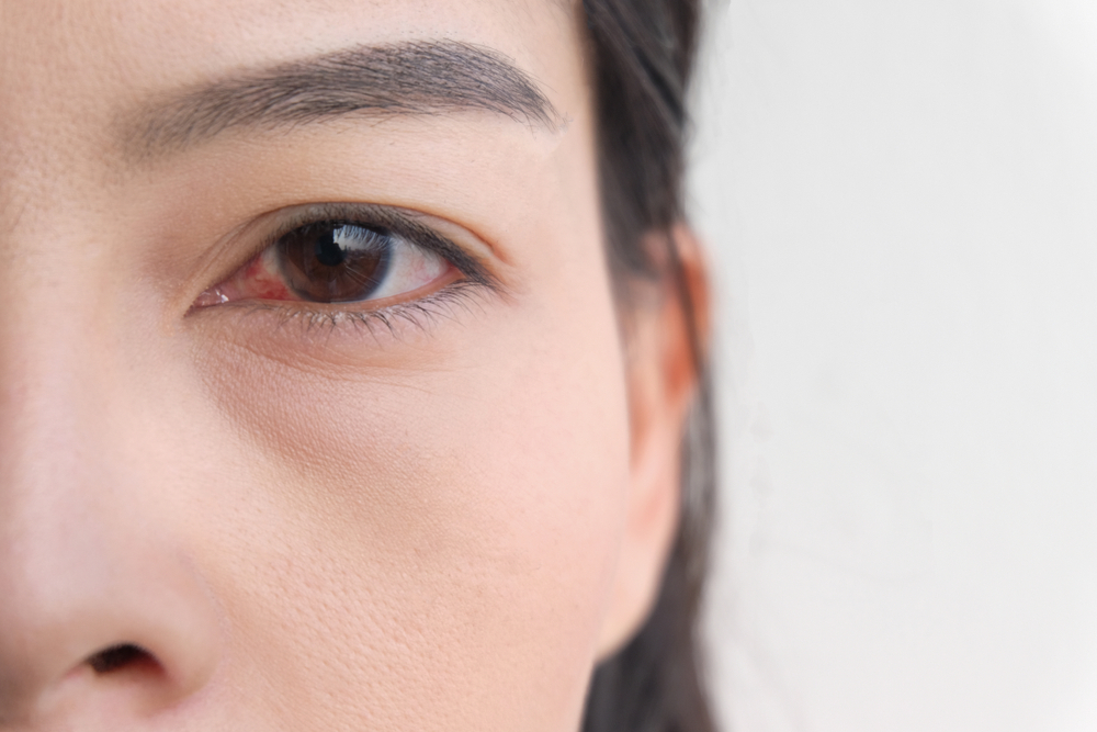 Khi nào nên đến bác sĩ nếu mạch máu mắt bị vỡ?