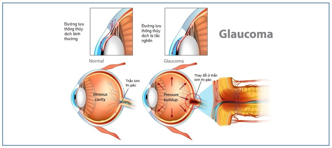 glaucoma