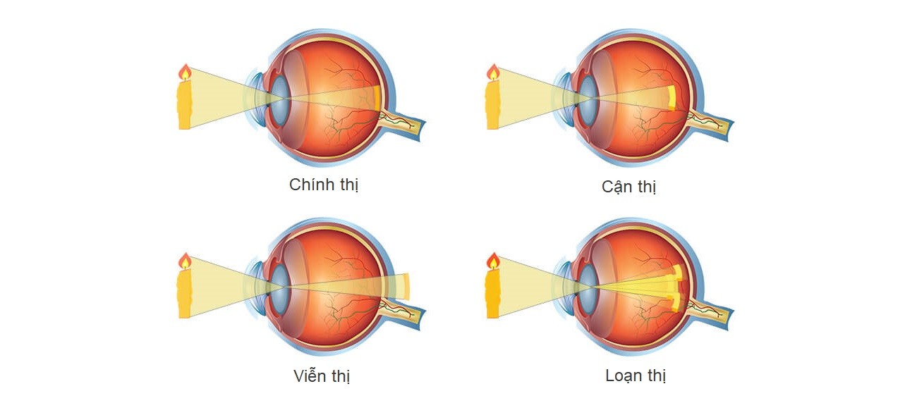 Tật khúc xạ