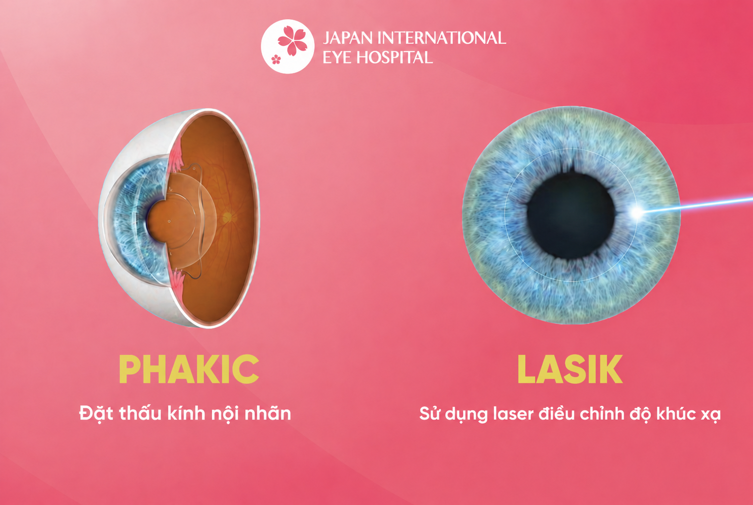 so-sanh-phau-thuat-phakic-va-laser