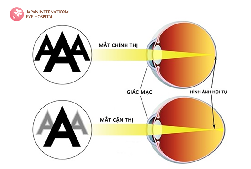 Minh họa mắt cận thị và mắt chính thị 