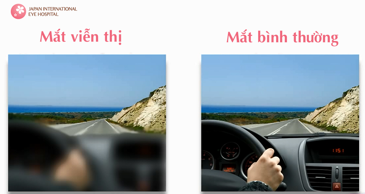 Minh họa tầm nhìn của người bệnh bị viễn thị Minh họa tầm nhìn của người bệnh bị viễn thị