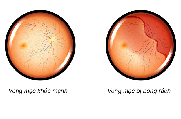 Nguy cơ bong rách võng mạc