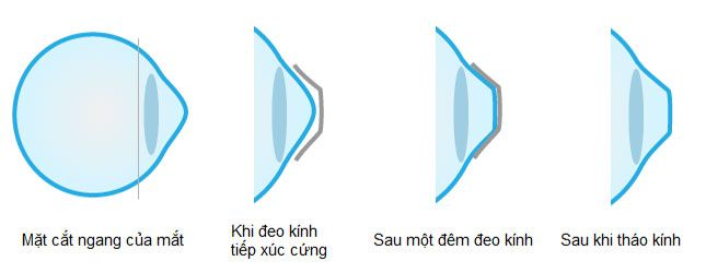 Minh họa cơ chế hoạt động của kính áp tròng Ortho-K
