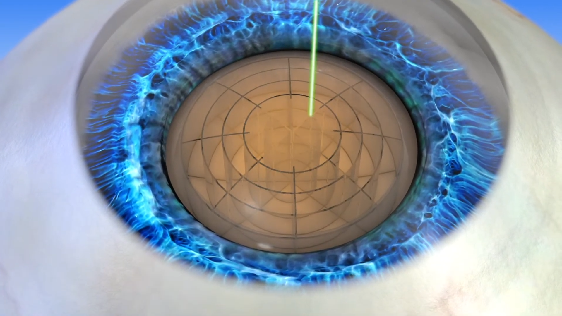 laser cataract laser-cataract