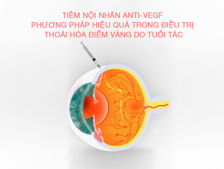 TIÊM NỘI NHÃN ANTI-VEGF - PHƯƠNG PHÁP HIỆU QUẢ TRONG ĐIỀU TRỊ THOÁI HÓA ĐIỂM VÀNG DO TUỔI TÁC