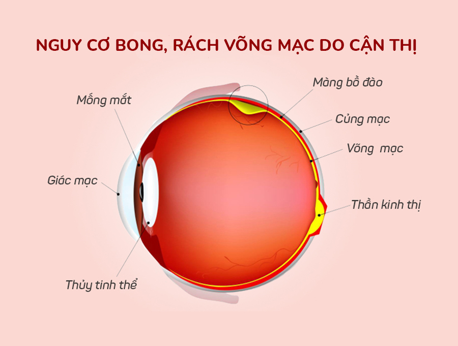 CẬN THỊ NẶNG VÀ NGUY CƠ BONG RÁCH VÕNG MẠC