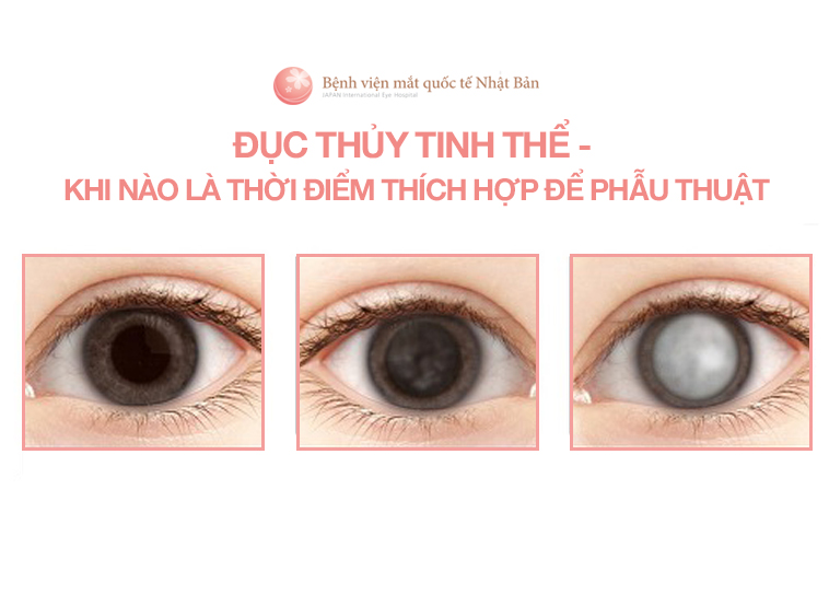 ĐỤC THỦY TINH THỂ - KHI NÀO LÀ THỜI ĐIỂM THÍCH HỢP ĐỂ PHẪU THUẬT