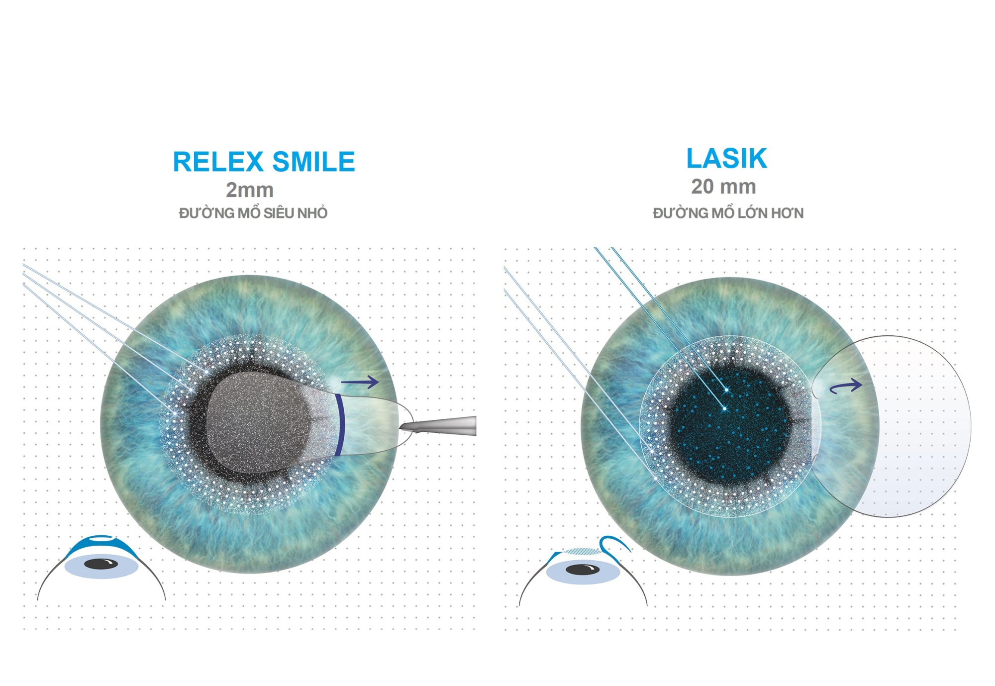 RELEX SMILE HAY FEMTOSECOND LASIK - NÊN MỔ CẬN BẰNG PHƯƠNG PHÁP NÀO?