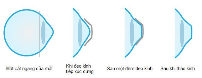ortho-k ortho-k