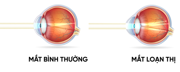 loạn thị loan-thi