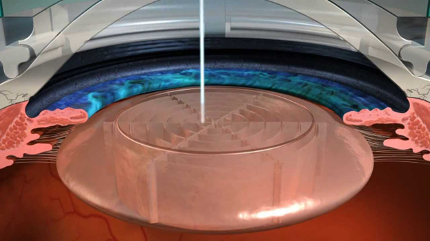 phẫu thuật Laser Cataract laser-cataract