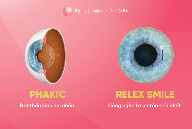 so sánh mổ cận so-sanh-mo-can