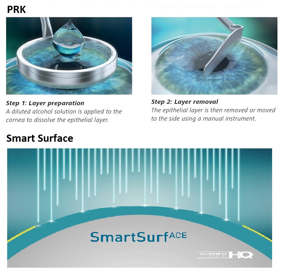 phẫu thuật prk và phẫu thuật smart surface