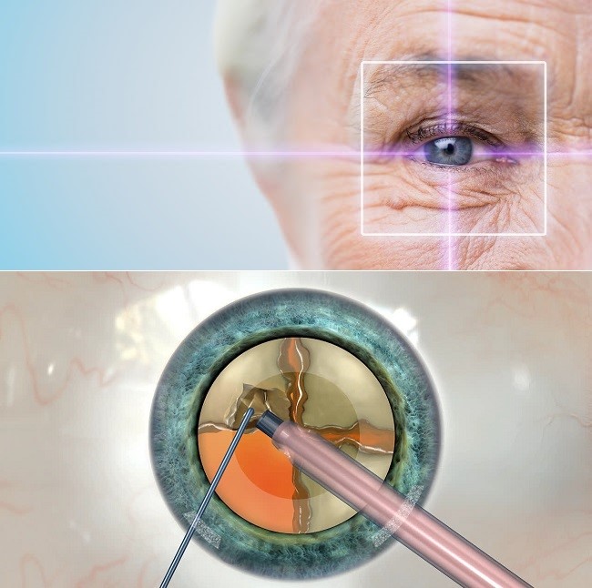 LASER CATARACT HAY PHACO – LỰA CHỌN ĐIỀU TRỊ ĐỤC THỦY TINH THỂ