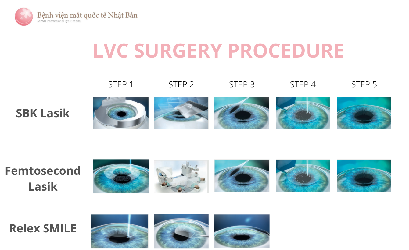Laser vision correction surgery procedure