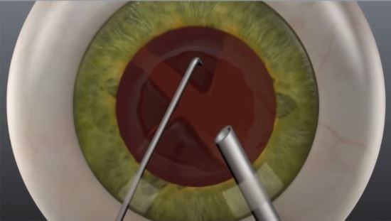 ​​Laser cataract surgery step 4