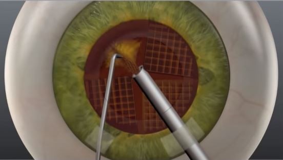 laser cataract surgery step 4