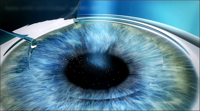 3. Direct multi-point Excimer laser onto the cornea below