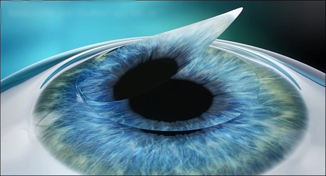 4. Return the corneal flap to its original location and complete the surgery.