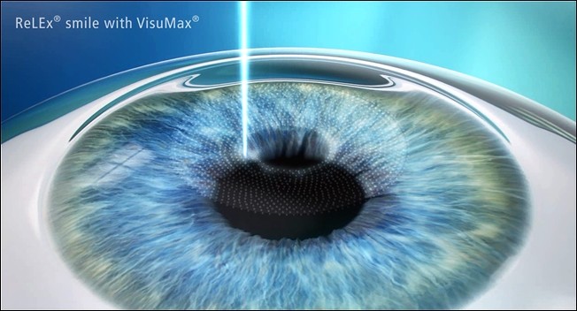 1. Using Femtosecond Laser energy to illuminate through the corneal surface, separating the middle core.
