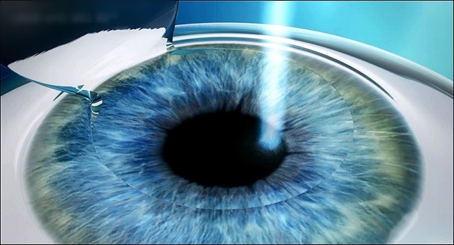 3. Apply a multi-point Excimer laser to remove myopia.