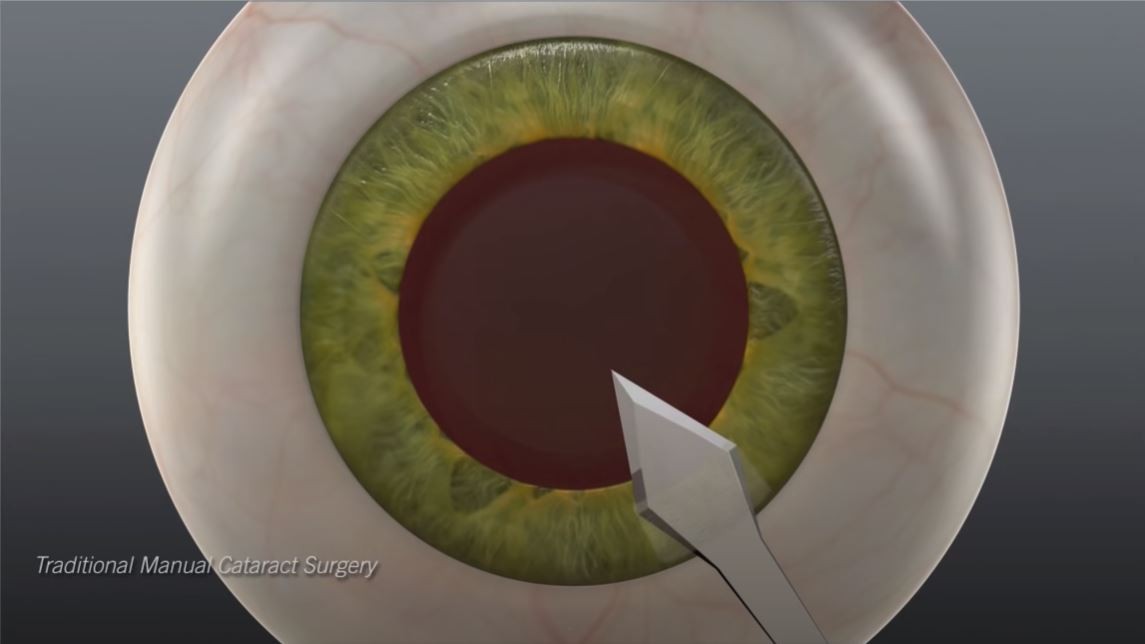 CREATE A SMALL INCISION ON THE CORNEAL EDGE USING A SURGICAL EQUIMENT