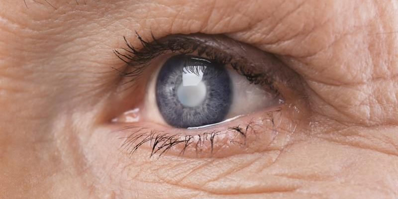 CATARACT SURGERY - COMPLICATIONS, SIDE EFFECTS AND RISKS