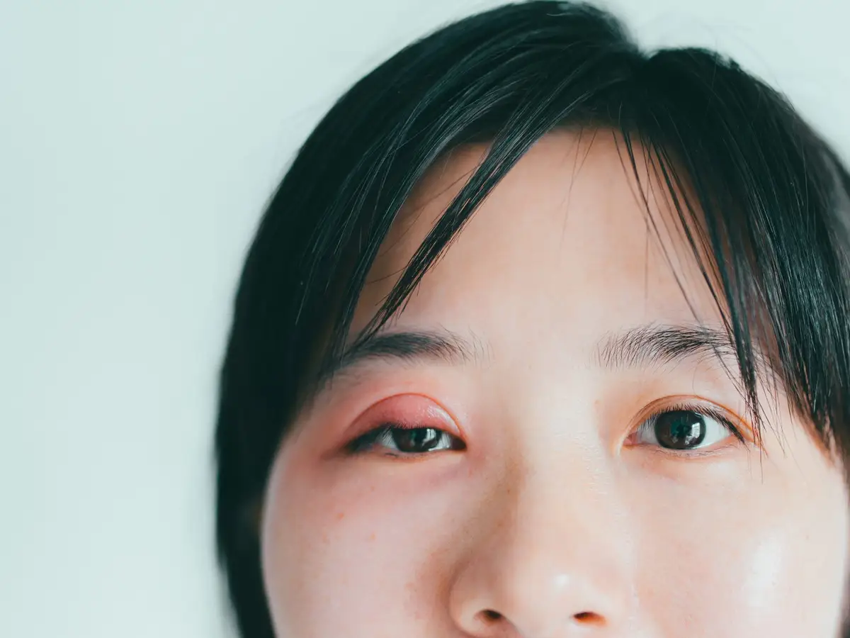 sưng mắt sung-mat